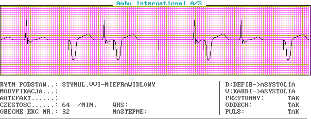 EKG wykresy z łyżek, Pierwsza Pomoc - c32-0.png