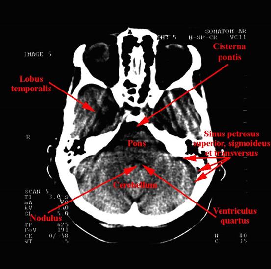 tomografia komputerowa głowy - 04c.jpg