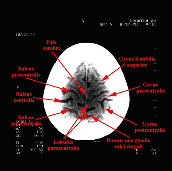 tomografia komputerowa głowy - 15.jpg